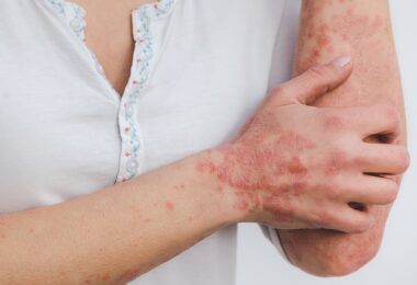 psoriasis 5996424 640 https://sainetdiet.com
